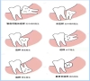 智齒一定要拔嗎？深圳拔牙邊間好？