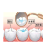 深圳牙齒塗氟跟窩溝封存的區別？