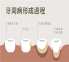 牙周病係點引起嘅？深圳口岸牙科治療幾錢？