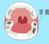 常見嘅牙齒齲齒有幾個情況？深圳口岸牙科邊間好？