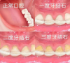 牙齒唔好好清潔會有邊啲傷害？深圳維港牙科洗牙幾錢？