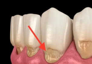 牙齒楔狀缺損一定要補牙嗎？深圳補牙價格？