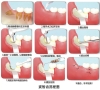 深圳拔牙過程?拔牙前後需注意什麼？