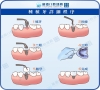 缺牙的修復方式有哪些？深圳種牙的步驟過程是怎樣的？