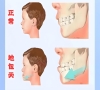 什麼是地包天？該如何預防？