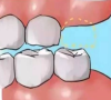 智慧牙拔出後對咬牙要拔嗎？深圳拔牙哪間好？