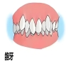 什麼是齙牙？齙牙該如何改善？