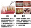 洗牙同牙齒美白有咩區別？深圳睇牙推薦？