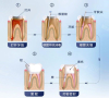 牙齒根管治療打樁痛唔痛？打樁係乜嘢？