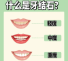 什麼情況需要洗牙？維港口腔洗牙收費？