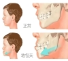 兒童牙齒反頜的危害？深圳箍牙價錢？