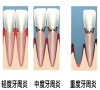 牙周炎可以種牙嗎？深圳種牙哪間好？