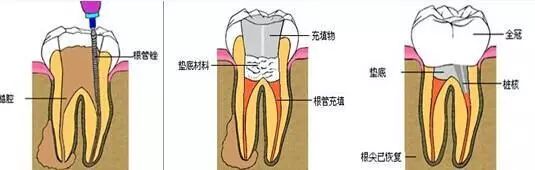 做根管治療有哪些注意事項？