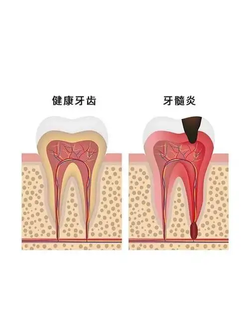 牙髓炎
