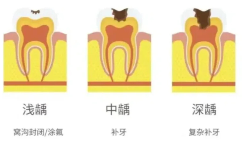 牙齒齲壞