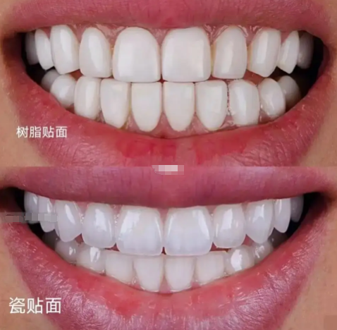维港口腔兩種牙貼面