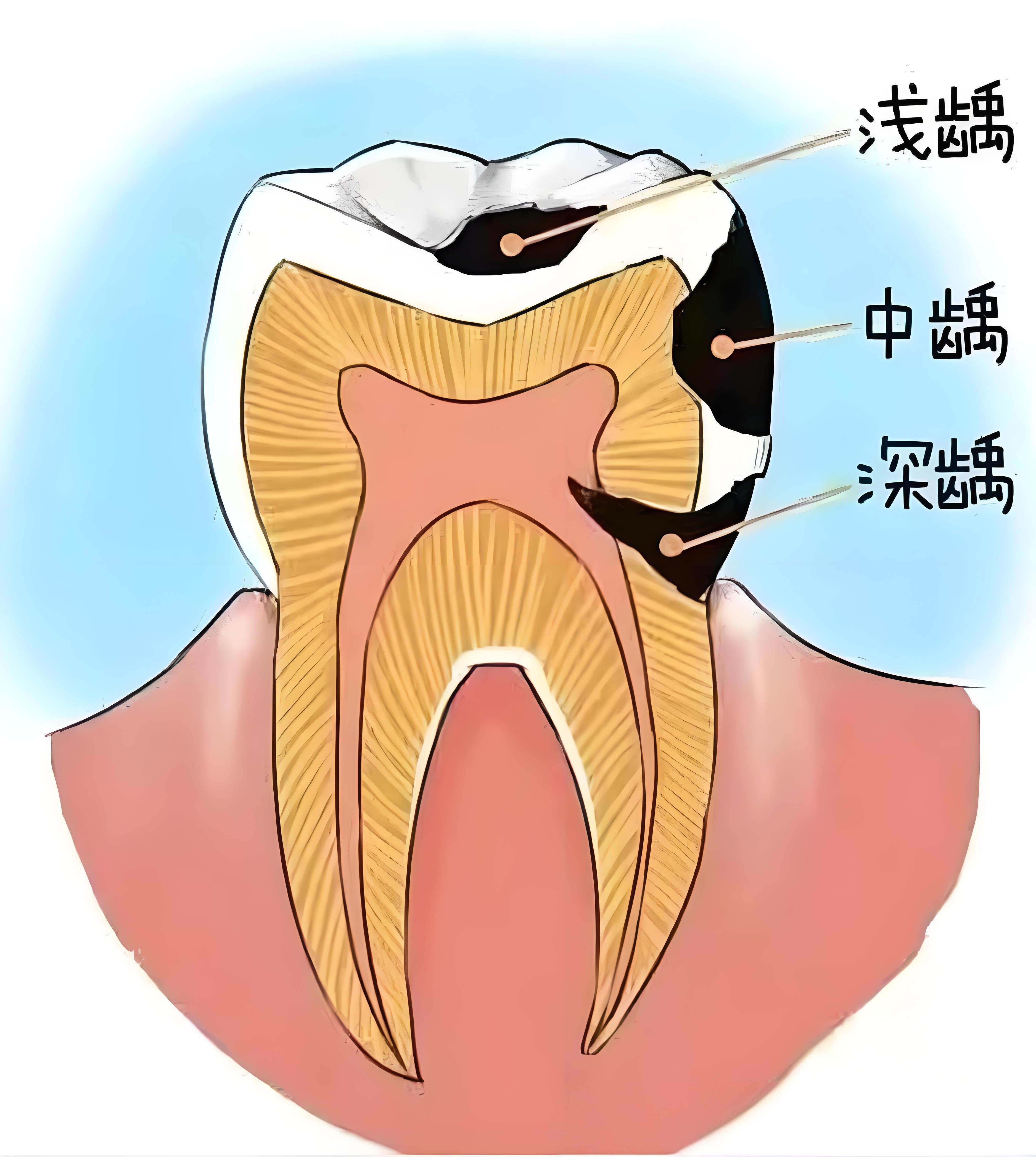齲齒（維港口腔）