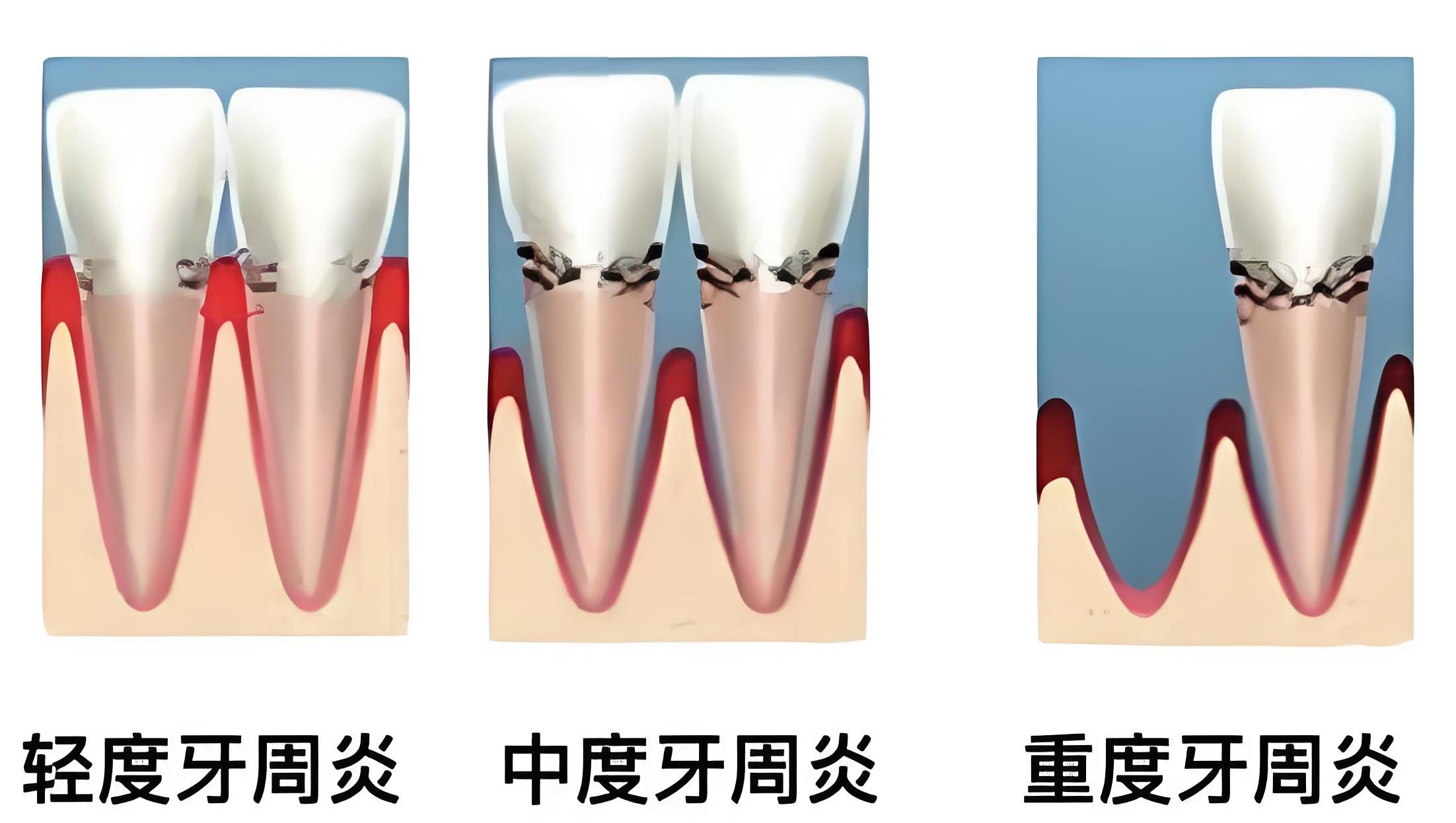 牙周炎圖片（維港口腔）