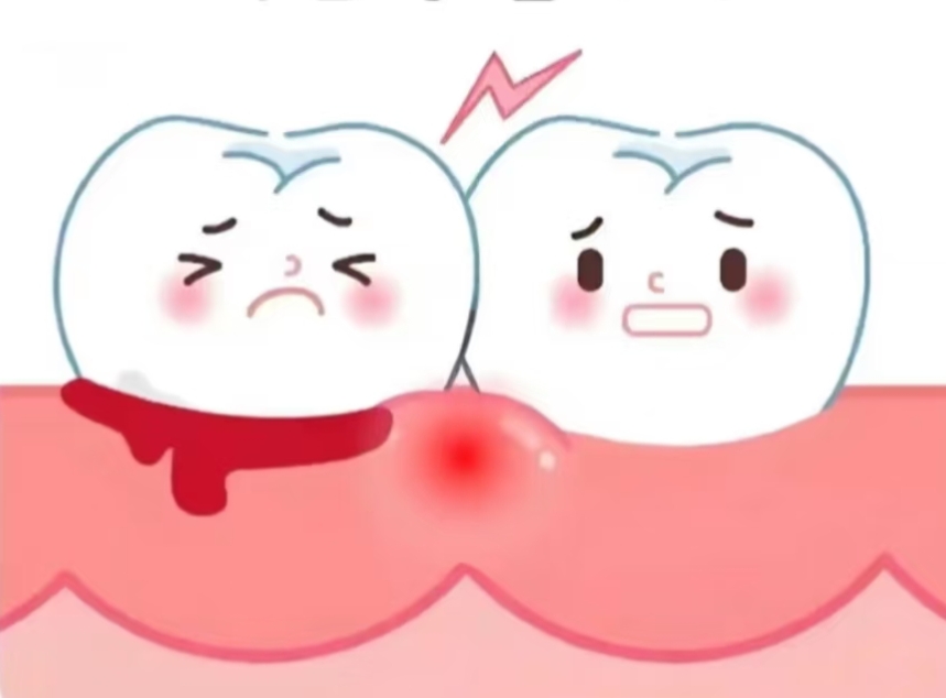 牙周病能自愈嗎?深圳牙周治療邊間好?
