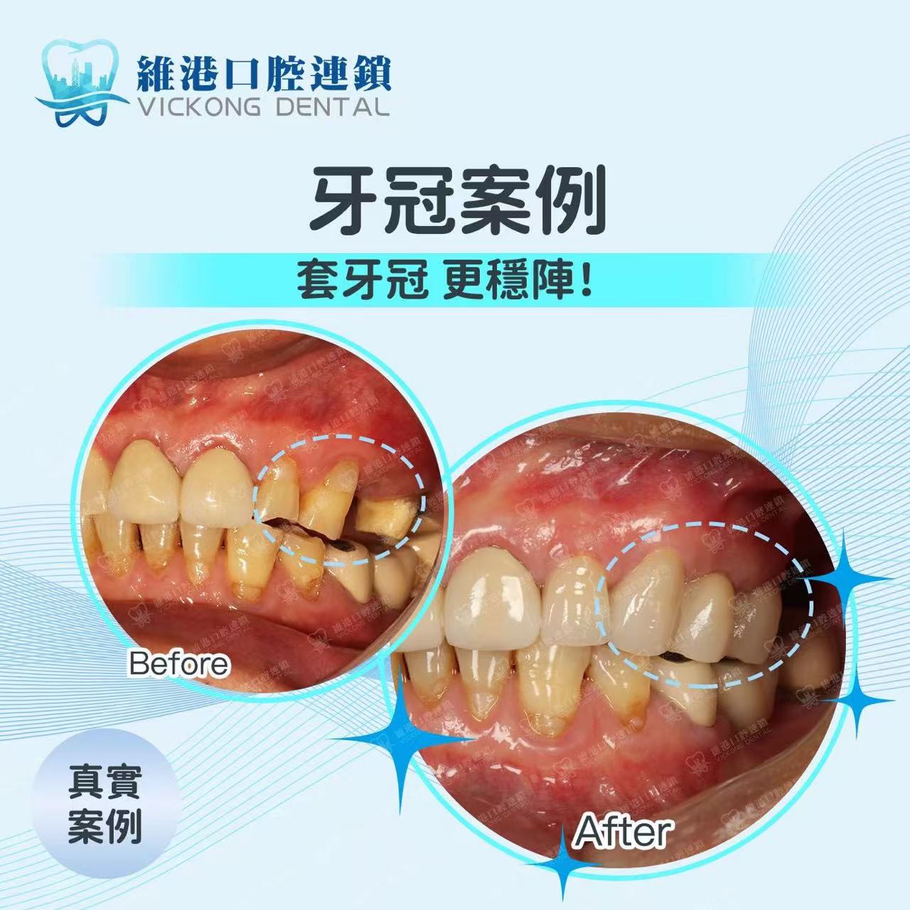 维港三康口腔牙冠前后对比图