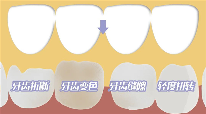 三康口腔牙贴面