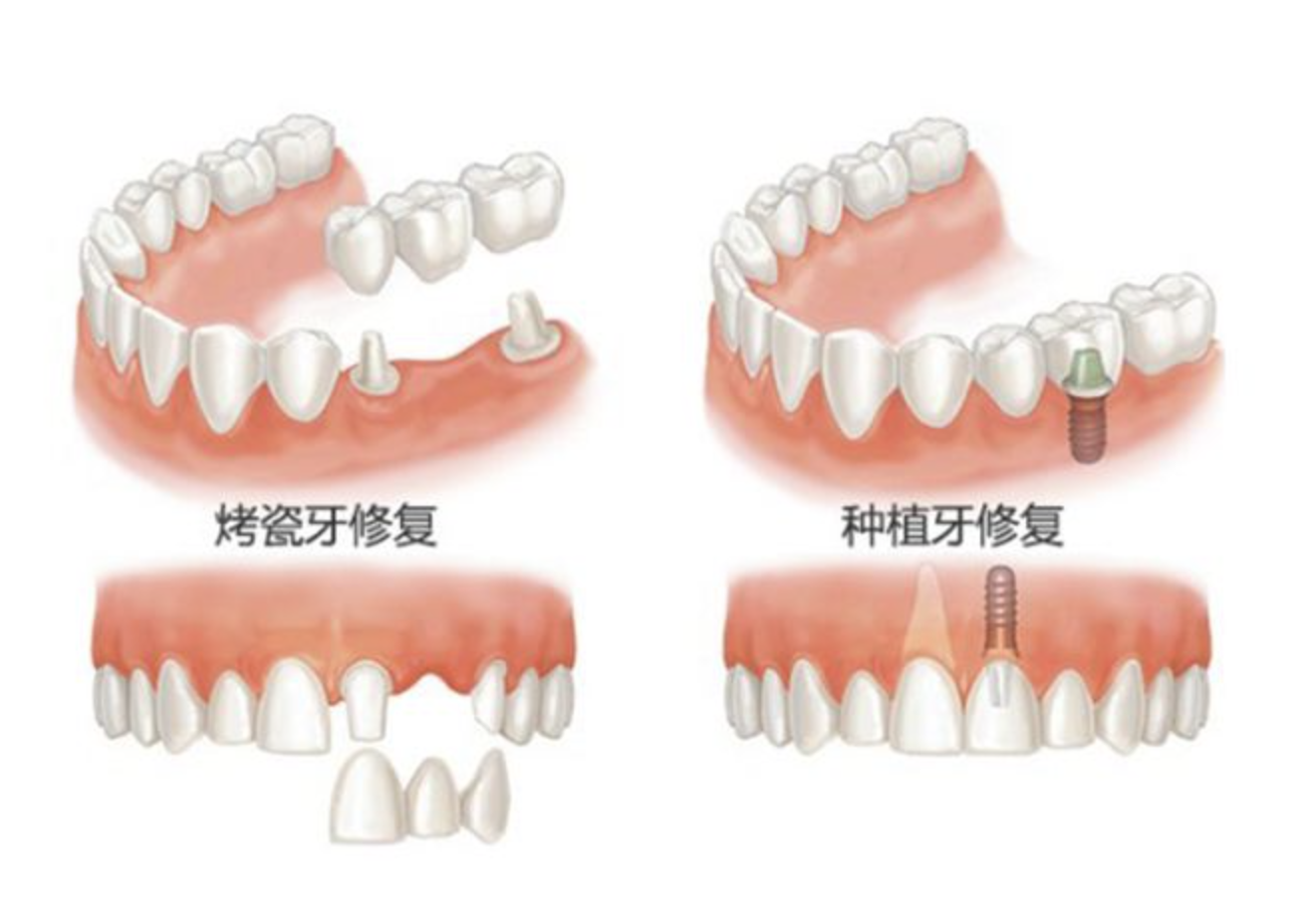 深圳三康镶牙