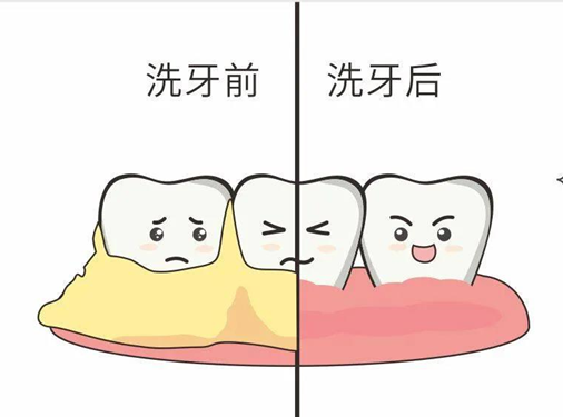 深圳维港洗牙