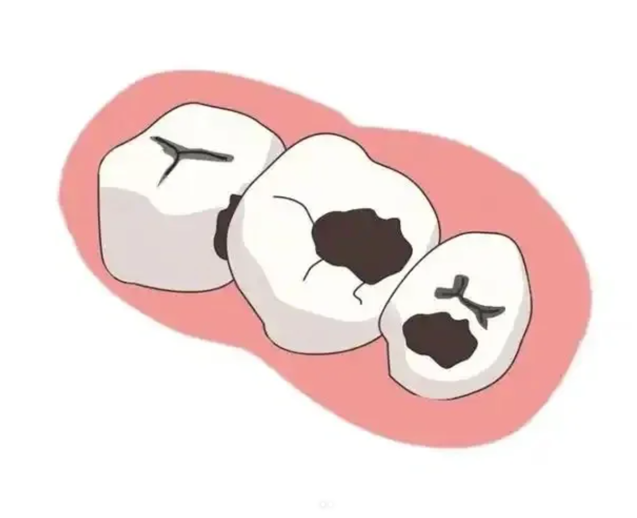 淺齲、中齲、深齲有什麼區別?北上睇牙邊間好?