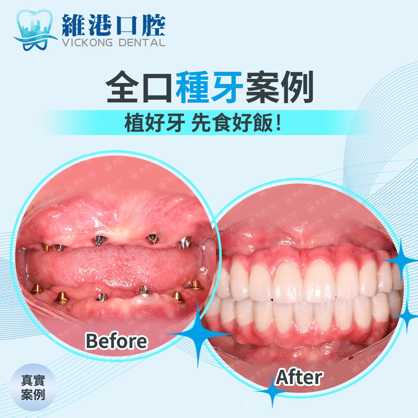 牙齒缺失後種牙好還是安裝假牙好？深圳睇牙邊間好？