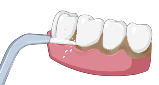 洗牙的4大常見誤區？羅湖牙科洗牙哪間好？