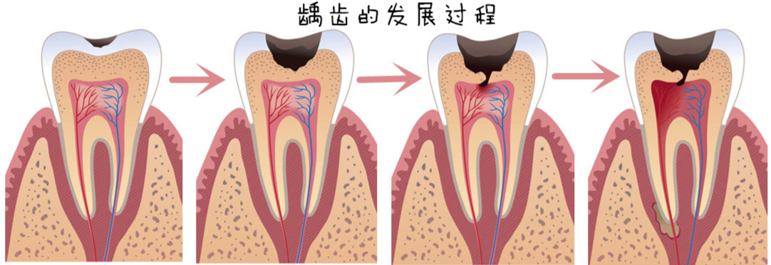 齲齒為什麼要儘早補牙？深圳補牙價錢？