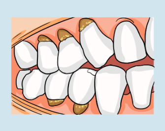 造成楔狀缺損的常見原因？北上睇牙推薦？