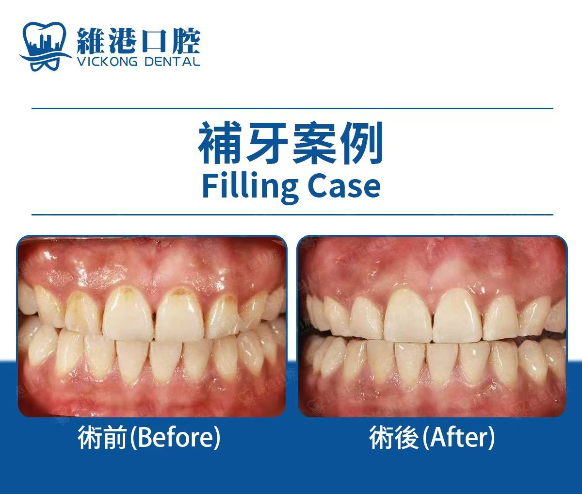 深圳維港口腔補牙案例參考 深圳維港口腔補牙案例參考