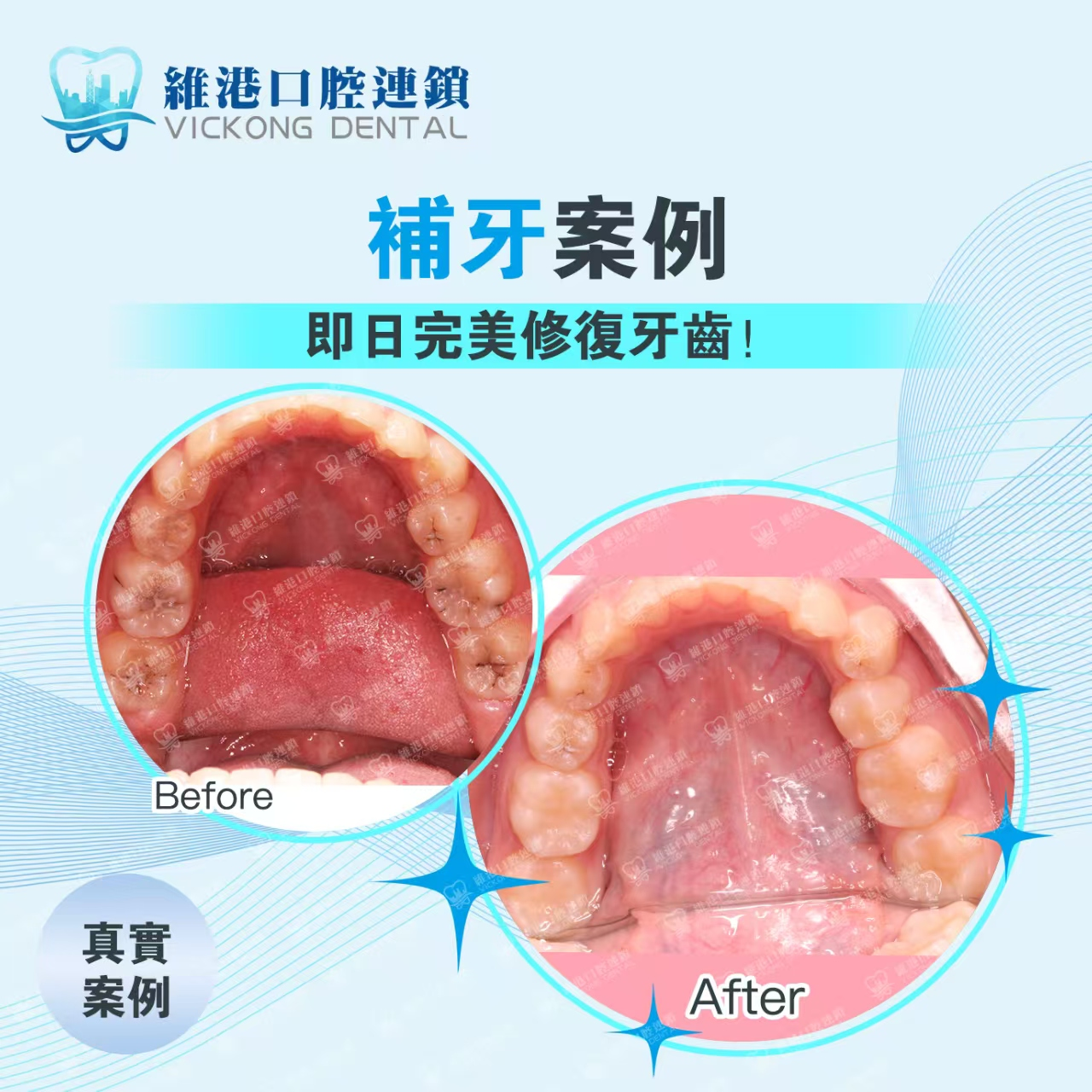 維港口腔補牙案例參考 維港口腔補牙案例參考
