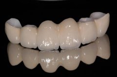 什麼因素會影響全瓷牙的使用壽命呢？
