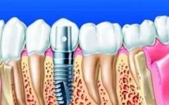 種植牙的過程是什麼？