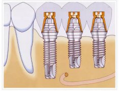 深圳種植牙的三個階段