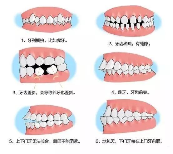 深圳箍牙,錯頜畸形,牙齒不齊,深圳箍牙價目表,三康口腔連鎖