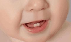 什么是全身麻醉下治疗儿童口腔疾病