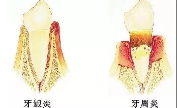 牙周炎