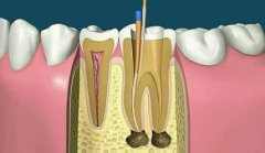 牙髓炎的常見診療措施