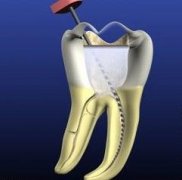 三康口腔連鎖帶你認識“牙神經痛”