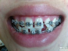 門牙一兩顆牙齒不齊，可以局部矯正嗎？
