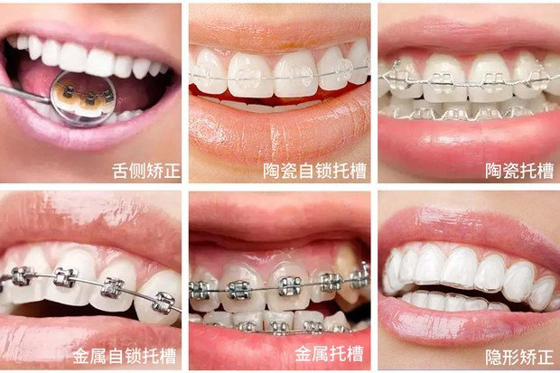 深圳箍牙-矯正器選擇，隱形牙套，金屬牙套
