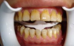 盤點牙齒發黃的5大因素